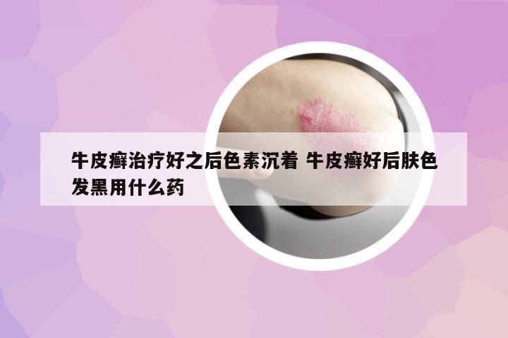 牛皮癬治療好之后色素沉著 牛皮癬好后膚色發(fā)黑用什么藥