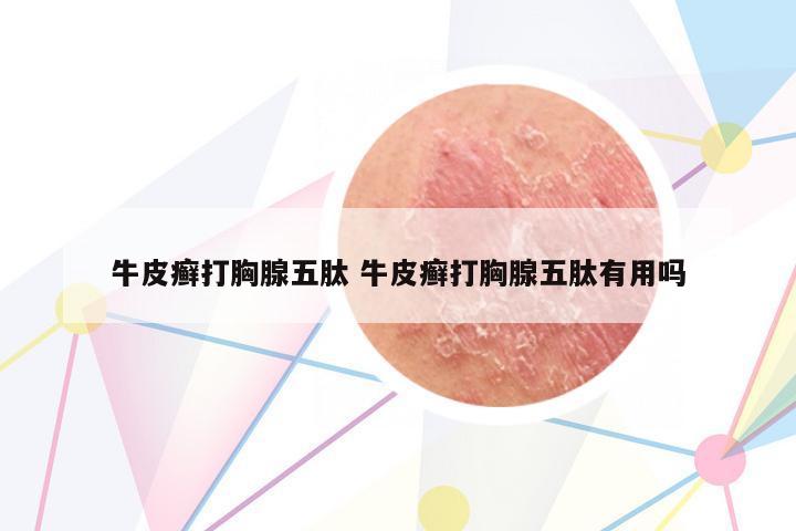 牛皮癬打胸腺五肽 牛皮癬打胸腺五肽有用嗎