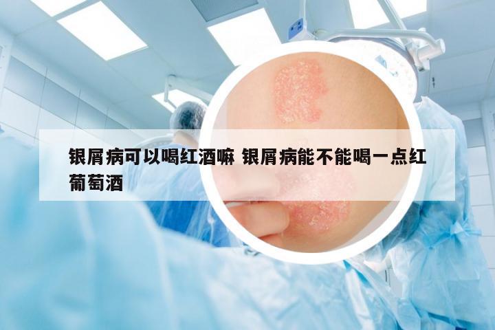 銀屑病可以喝紅酒嘛 銀屑病能不能喝一點紅葡萄酒