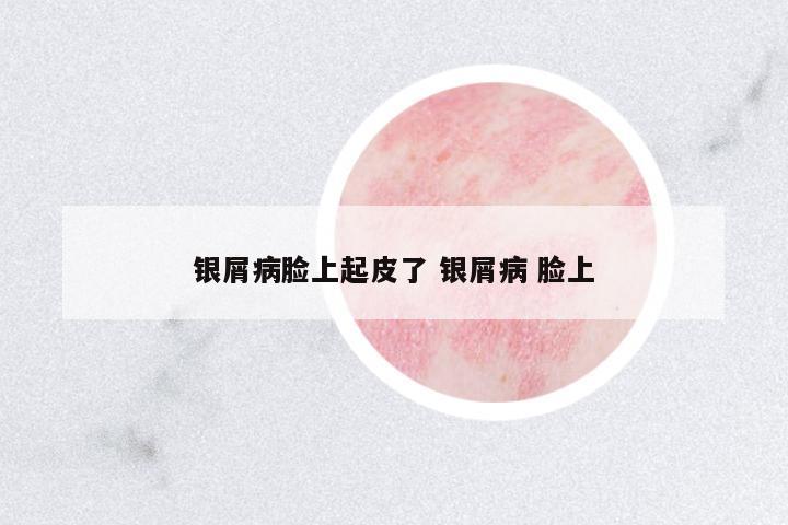 銀屑病臉上起皮了 銀屑病 臉上