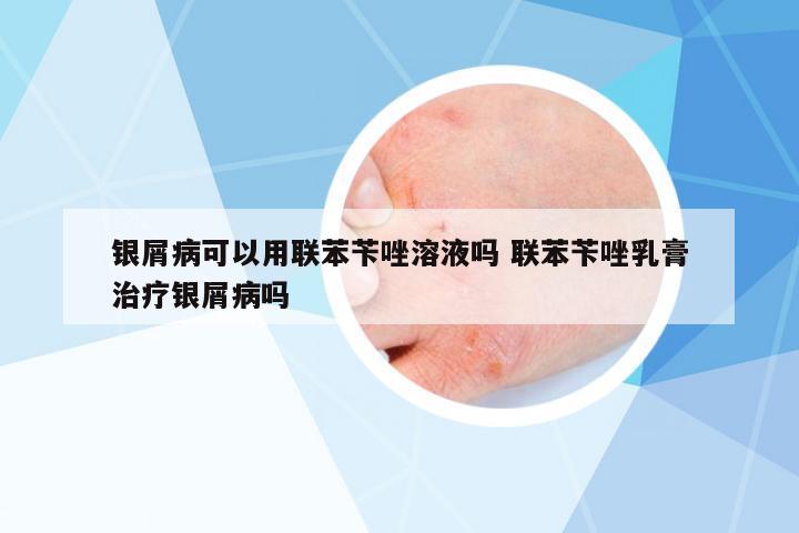 銀屑病可以用聯(lián)苯芐唑溶液嗎 聯(lián)苯芐唑乳膏治療銀屑病嗎