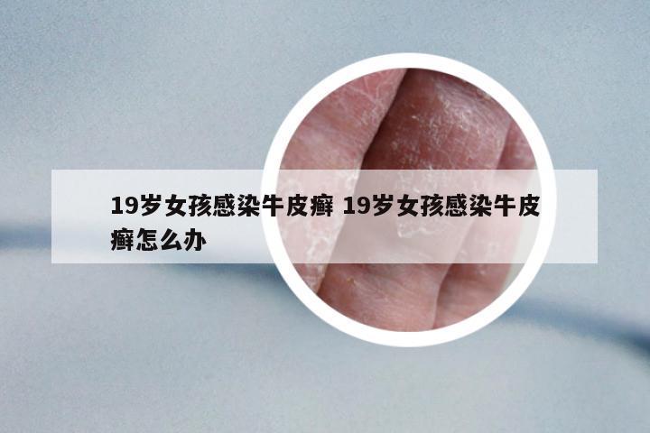 19歲女孩感染牛皮癬 19歲女孩感染牛皮癬怎么辦