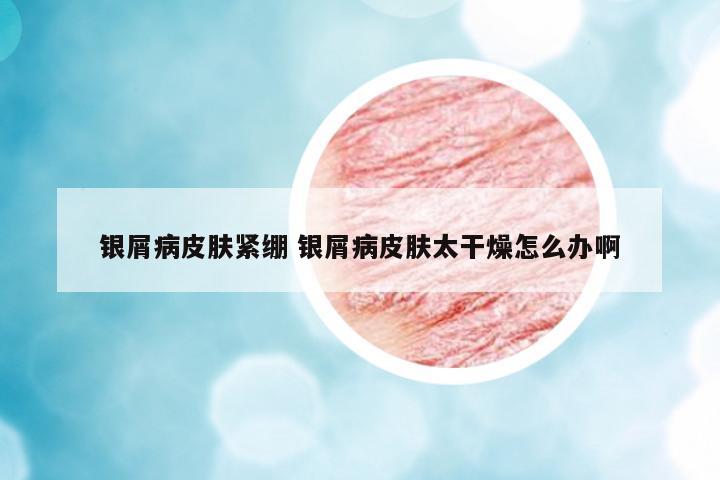 銀屑病皮膚緊繃 銀屑病皮膚太干燥怎么辦啊