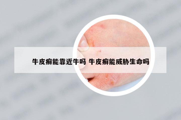 牛皮癬能靠近牛嗎 牛皮癬能威脅生命嗎