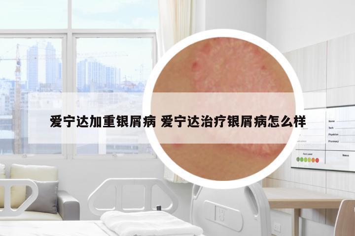 愛寧達(dá)加重銀屑病 愛寧達(dá)治療銀屑病怎么樣