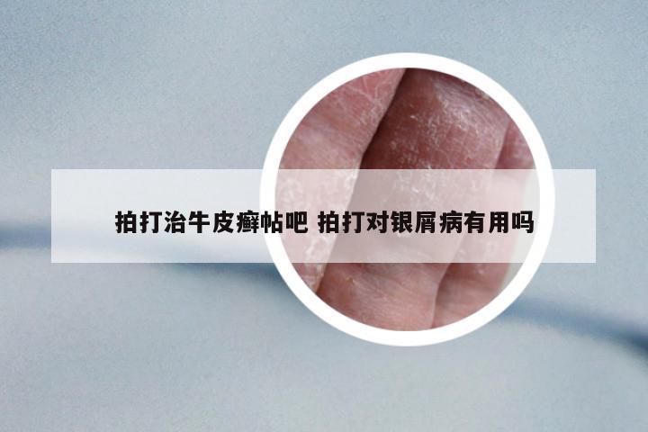 拍打治牛皮癬帖吧 拍打?qū)︺y屑病有用嗎