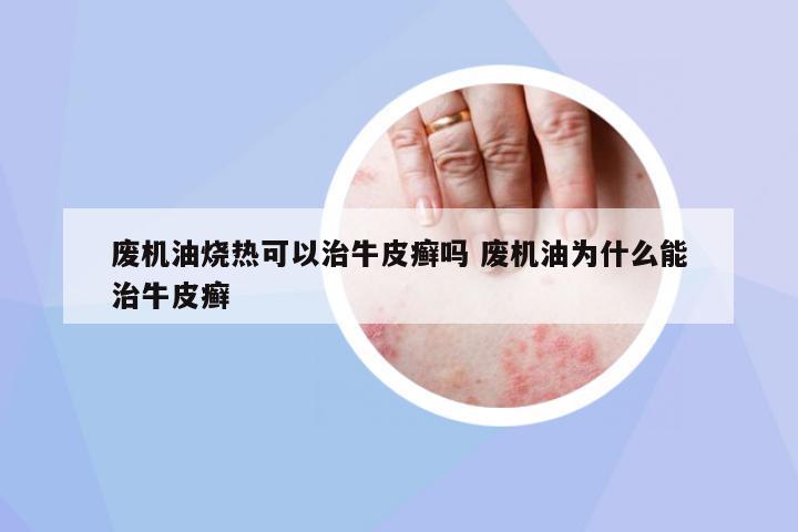 廢機(jī)油燒熱可以治牛皮癬嗎 廢機(jī)油為什么能治牛皮癬