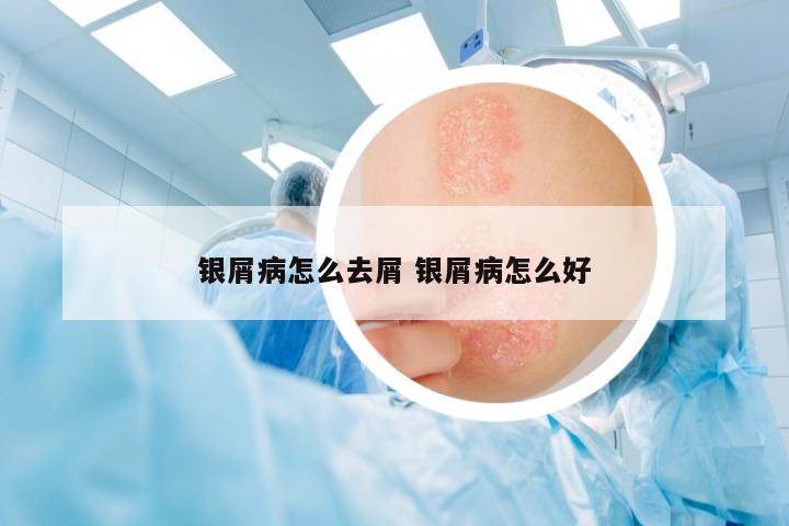銀屑病怎么去屑 銀屑病怎么好