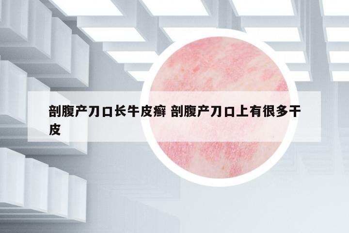 剖腹產(chǎn)刀口長牛皮癬 剖腹產(chǎn)刀口上有很多干皮