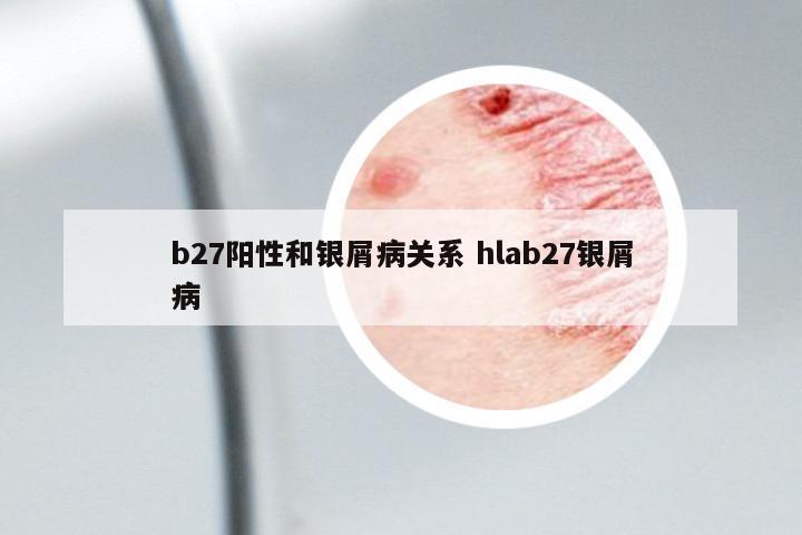 b27陽性和銀屑病關系 hlab27銀屑病