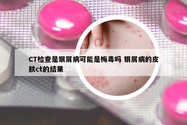CT檢查是銀屑病可能是梅毒嗎 銀屑病的皮膚ct的結(jié)果