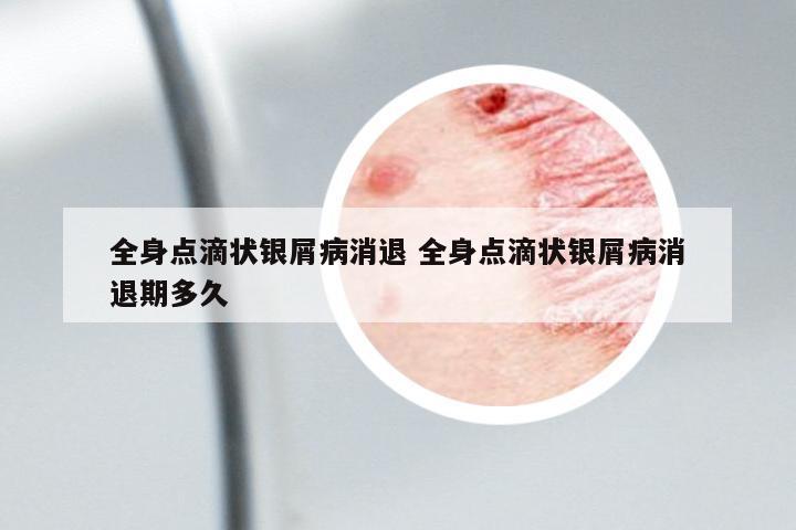 全身點(diǎn)滴狀銀屑病消退 全身點(diǎn)滴狀銀屑病消退期多久