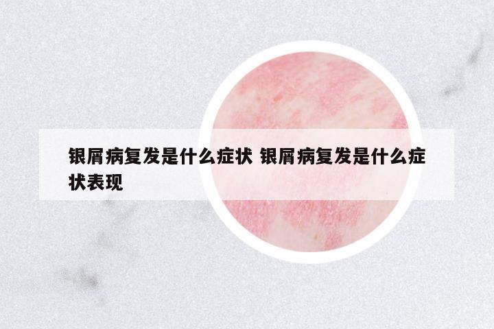 銀屑病復(fù)發(fā)是什么癥狀 銀屑病復(fù)發(fā)是什么癥狀表現(xiàn)