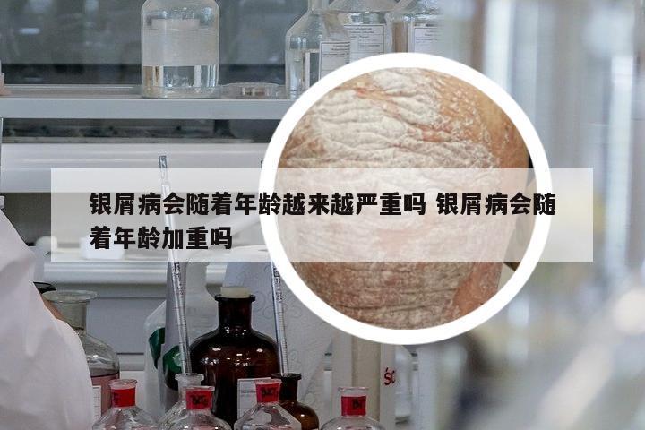 銀屑病會(huì)隨著年齡越來(lái)越嚴(yán)重嗎 銀屑病會(huì)隨著年齡加重嗎