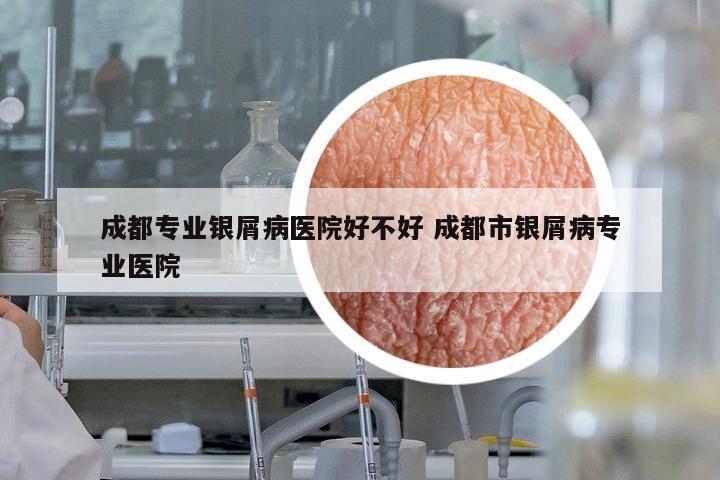 成都專業(yè)銀屑病醫(yī)院好不好 成都市銀屑病專業(yè)醫(yī)院