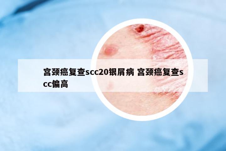 宮頸癌復(fù)查scc20銀屑病 宮頸癌復(fù)查scc偏高