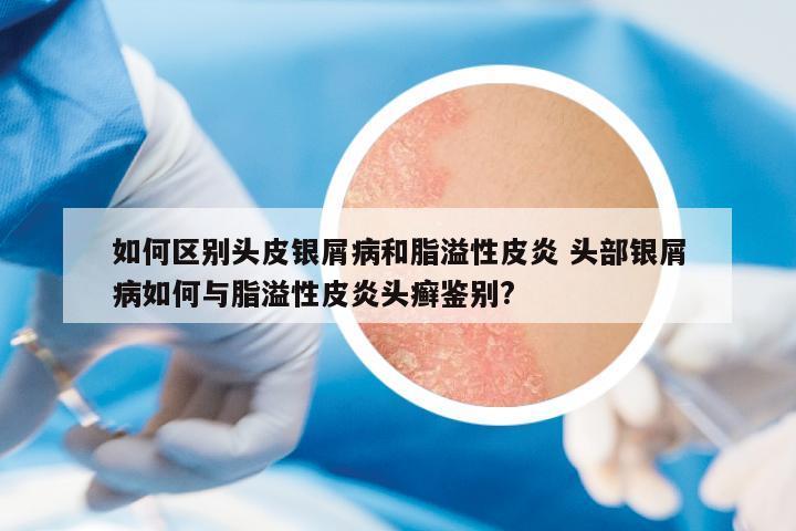如何區(qū)別頭皮銀屑病和脂溢性皮炎 頭部銀屑病如何與脂溢性皮炎頭癬鑒別?