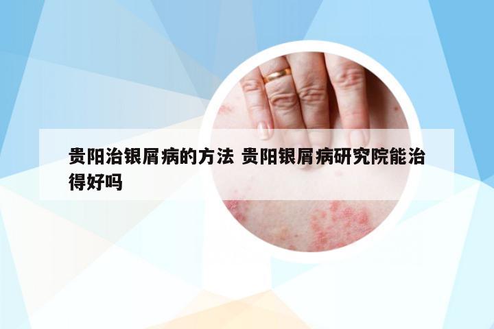 貴陽治銀屑病的方法 貴陽銀屑病研究院能治得好嗎