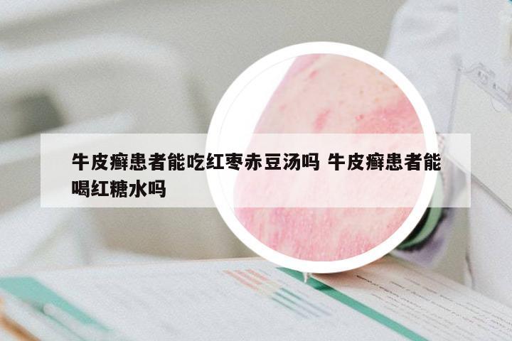 牛皮癬患者能吃紅棗赤豆湯嗎 牛皮癬患者能喝紅糖水嗎