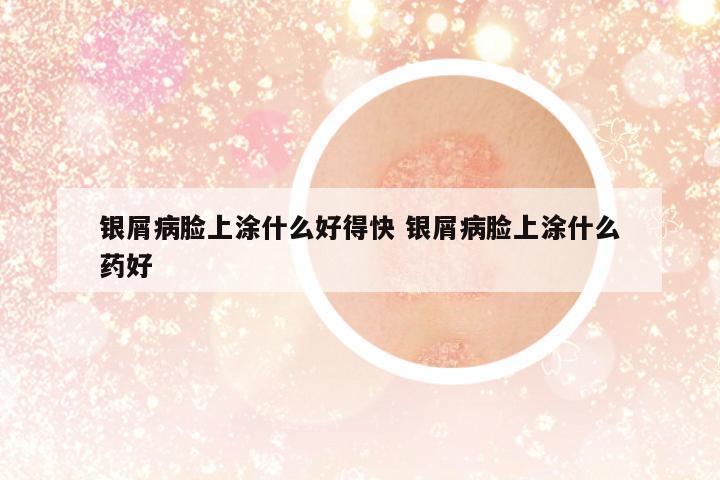 銀屑病臉上涂什么好得快 銀屑病臉上涂什么藥好