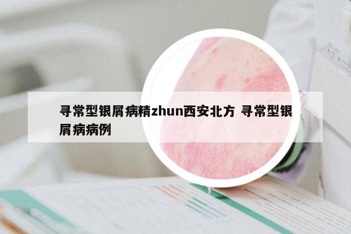 尋常型銀屑病精zhun西安北方 尋常型銀屑病病例