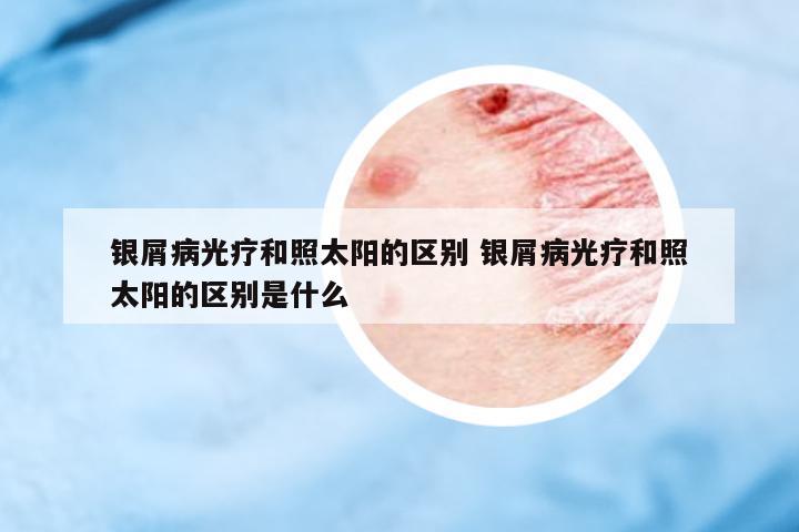 銀屑病光療和照太陽(yáng)的區(qū)別 銀屑病光療和照太陽(yáng)的區(qū)別是什么