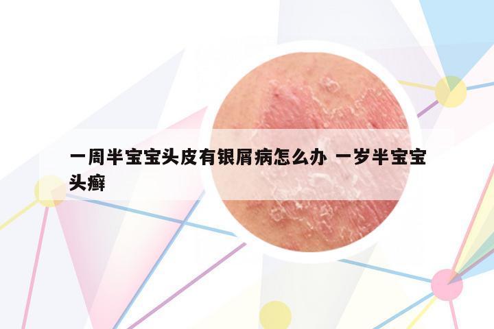一周半寶寶頭皮有銀屑病怎么辦 一歲半寶寶頭癬