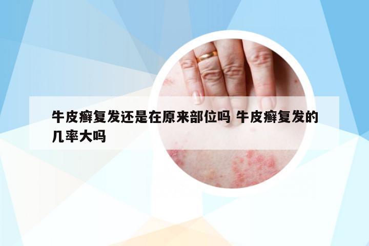 牛皮癬復(fù)發(fā)還是在原來(lái)部位嗎 牛皮癬復(fù)發(fā)的幾率大嗎