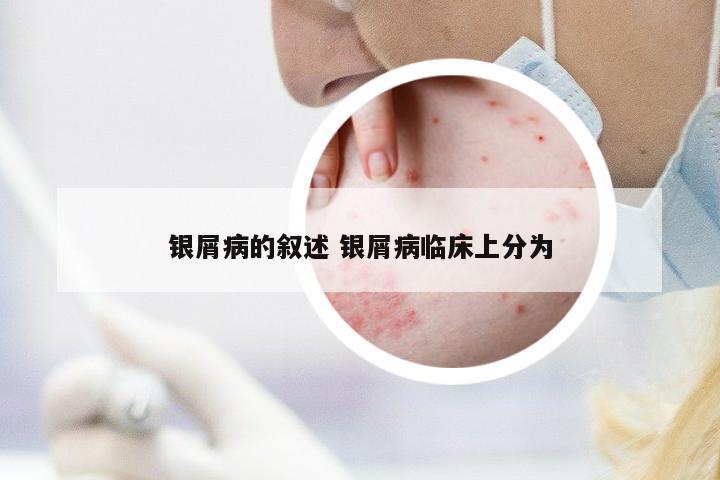 銀屑病的敘述 銀屑病臨床上分為
