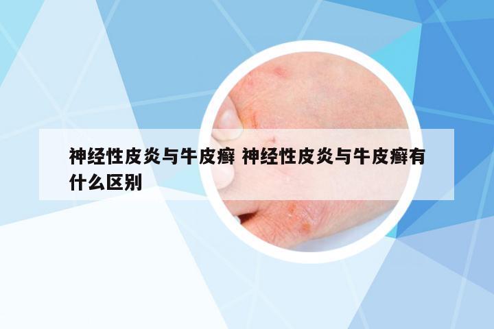 神經(jīng)性皮炎與牛皮癬 神經(jīng)性皮炎與牛皮癬有什么區(qū)別