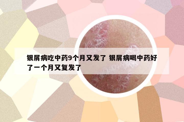 銀屑病吃中藥9個(gè)月又發(fā)了 銀屑病喝中藥好了一個(gè)月又復(fù)發(fā)了
