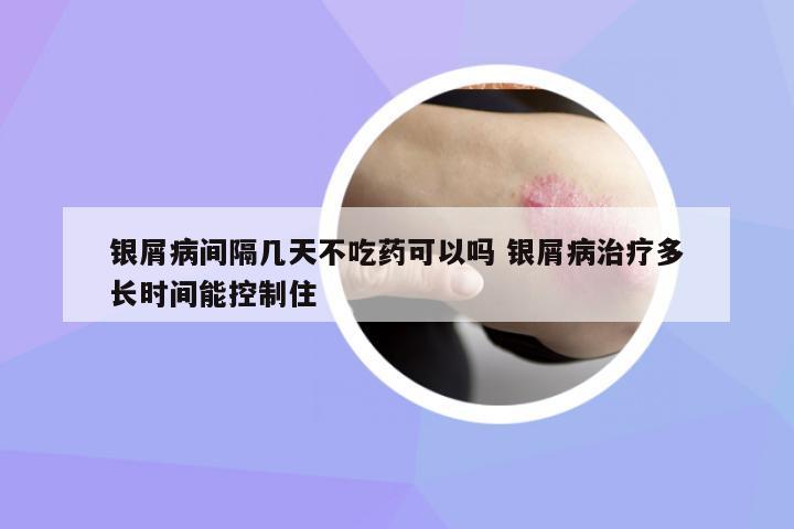 銀屑病間隔幾天不吃藥可以嗎 銀屑病治療多長時間能控制住
