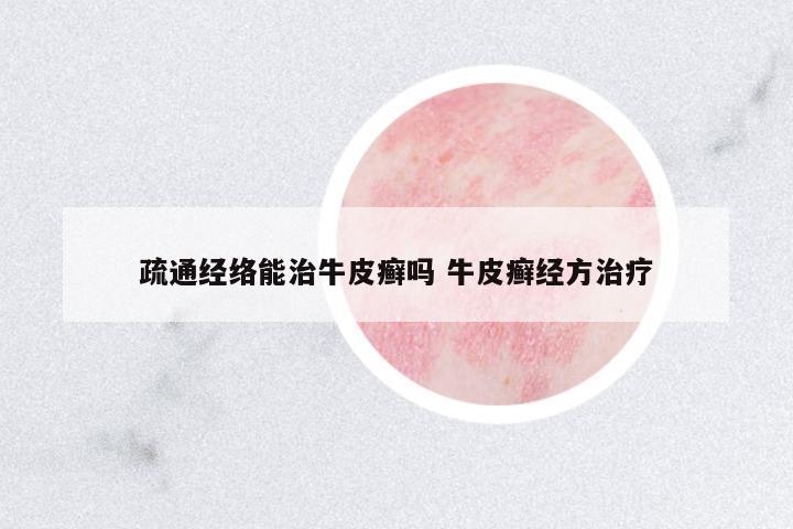 疏通經(jīng)絡(luò)能治牛皮癬嗎 牛皮癬經(jīng)方治療