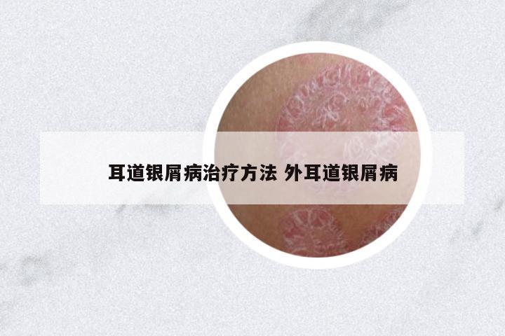 耳道銀屑病治療方法 外耳道銀屑病