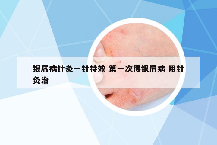 銀屑病針灸一針特效 第一次得銀屑病 用針灸治