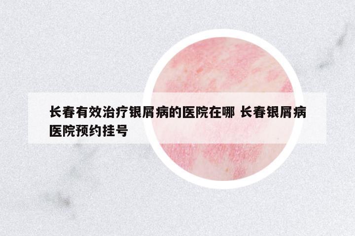 長春有效治療銀屑病的醫(yī)院在哪 長春銀屑病醫(yī)院預約掛號
