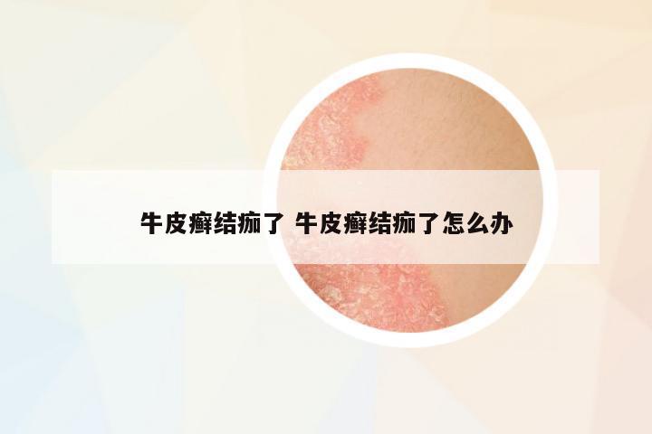牛皮癬結(jié)痂了 牛皮癬結(jié)痂了怎么辦
