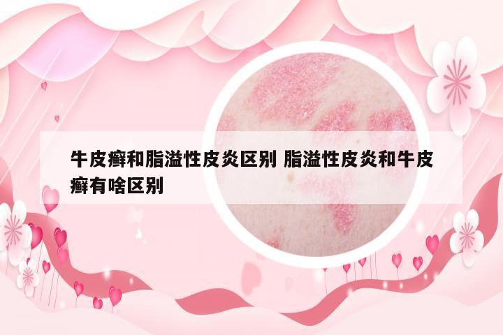 牛皮癬和脂溢性皮炎區(qū)別 脂溢性皮炎和牛皮癬有啥區(qū)別