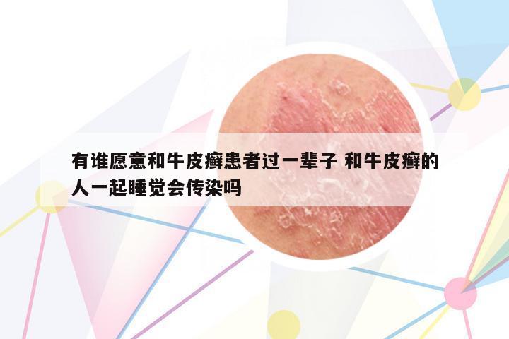 有誰(shuí)愿意和牛皮癬患者過(guò)一輩子 和牛皮癬的人一起睡覺(jué)會(huì)傳染嗎
