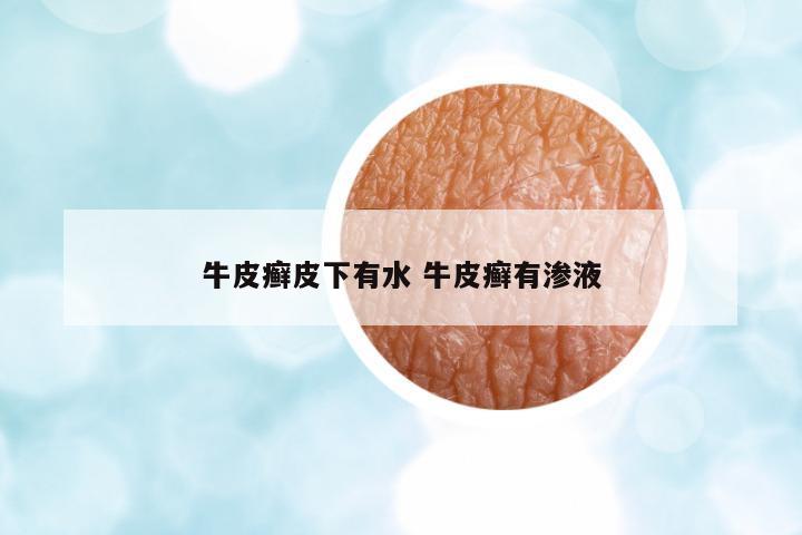 牛皮癬皮下有水 牛皮癬有滲液