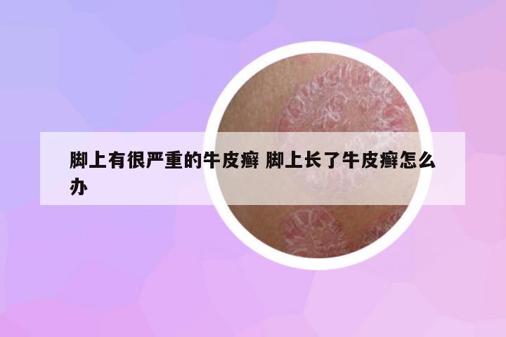 腳上有很嚴重的牛皮癬 腳上長了牛皮癬怎么辦