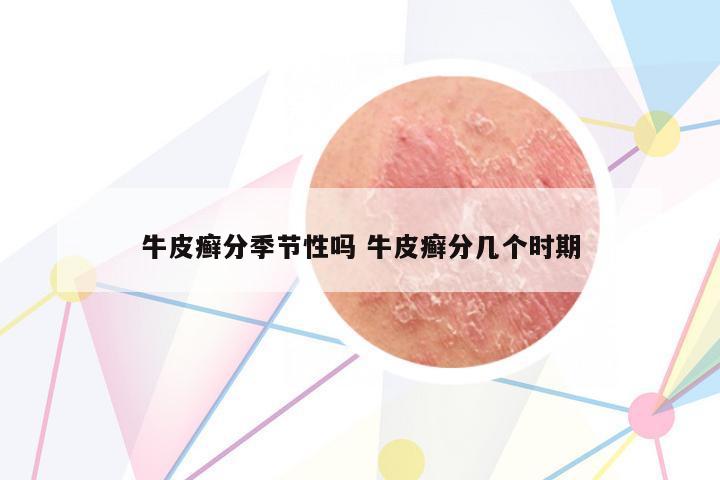 牛皮癬分季節(jié)性嗎 牛皮癬分幾個時期