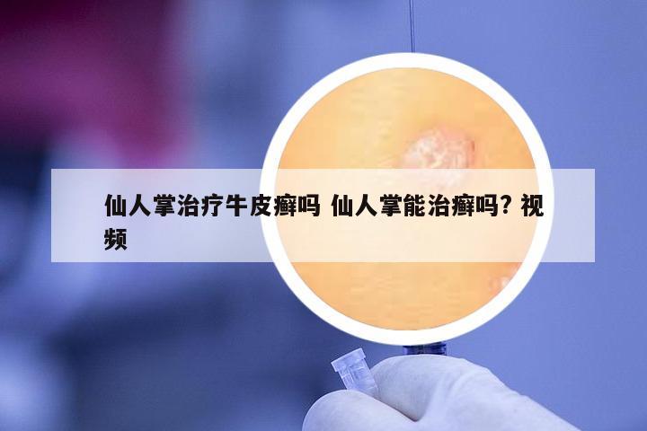 仙人掌治療牛皮癬嗎 仙人掌能治癬嗎? 視頻