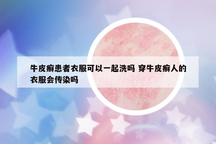 牛皮癬患者衣服可以一起洗嗎 穿牛皮癬人的衣服會傳染嗎