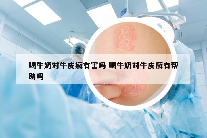 喝牛奶對牛皮癬有害嗎 喝牛奶對牛皮癬有幫助嗎