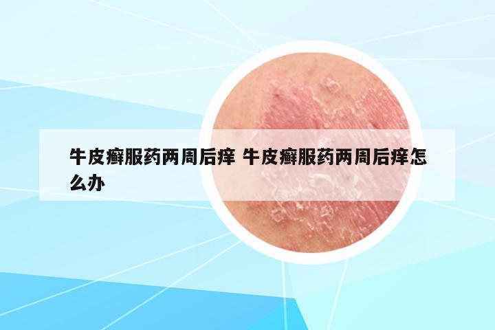 牛皮癬服藥兩周后癢 牛皮癬服藥兩周后癢怎么辦