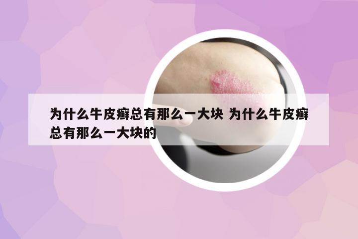 為什么牛皮癬總有那么一大塊 為什么牛皮癬總有那么一大塊的