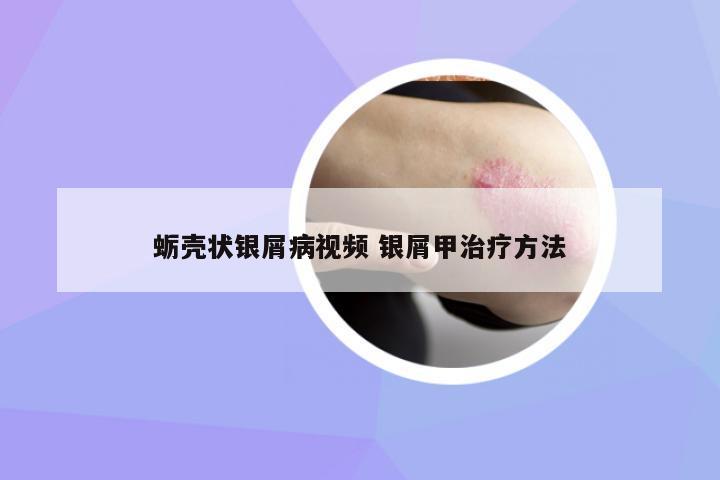 蠣殼狀銀屑病視頻 銀屑甲治療方法