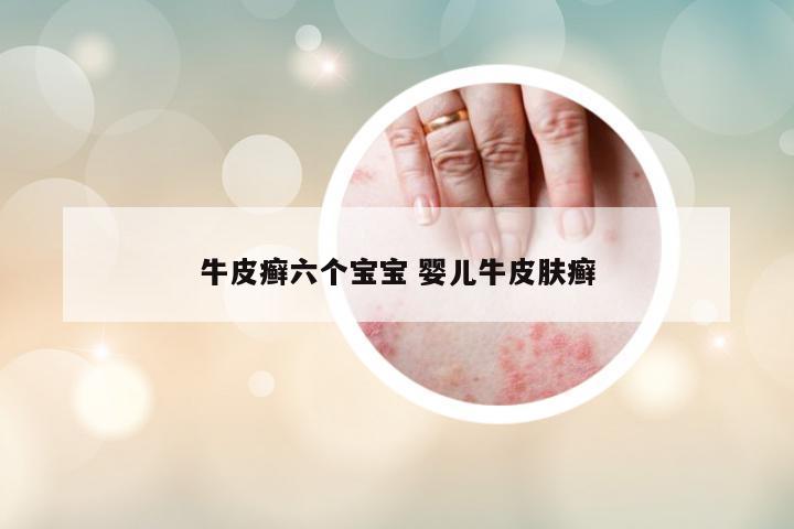 牛皮癬六個(gè)寶寶 嬰兒牛皮膚癬