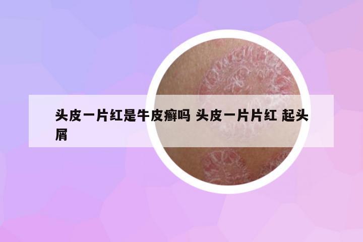 頭皮一片紅是牛皮癬嗎 頭皮一片片紅 起頭屑
